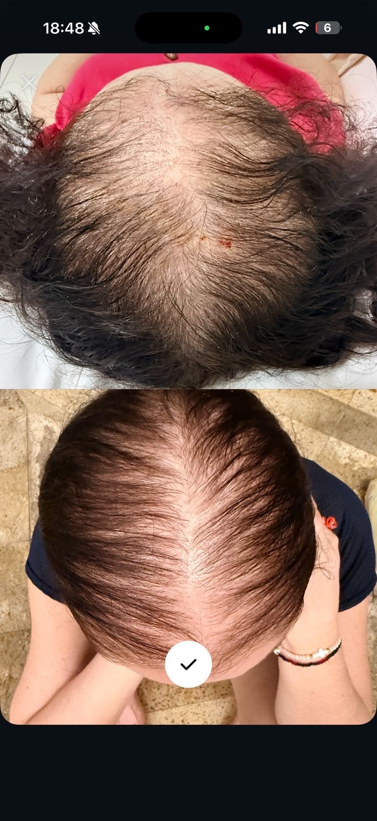 Antes e depois capilar